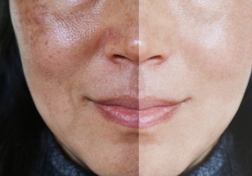 Can you reverse uneven skin tone?